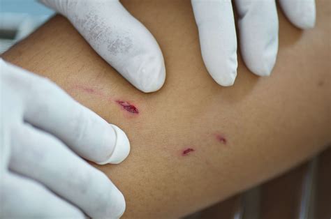 ANIMAL BITE .